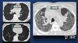 Lung scans show COVID-19 can leave severe damage, even in those who didn't have symptoms 