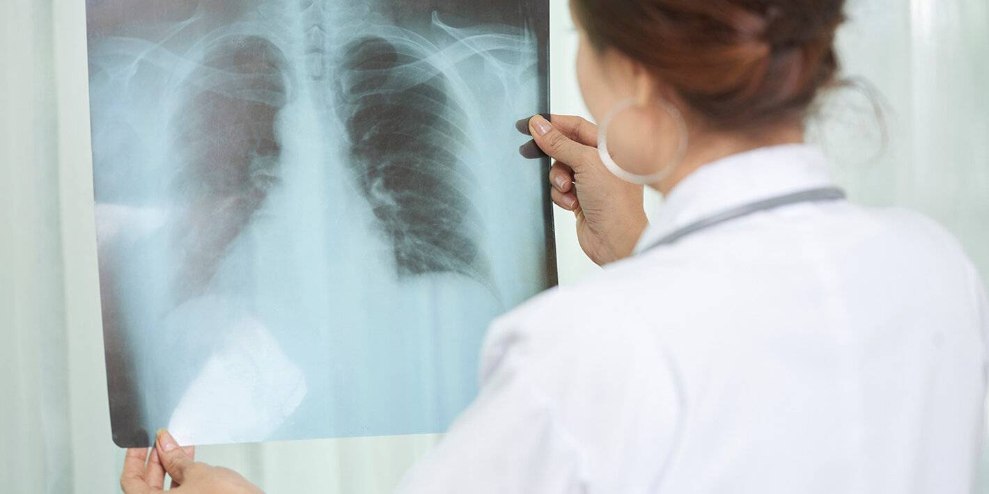 Diagnosis of new TB cases in the Americas reduced by 15-20% during 2020 due to the pandemic 